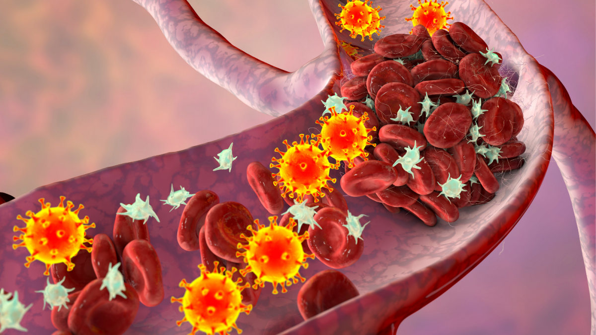 Covid-19: Blutgefäß mit Thrombus und Viren